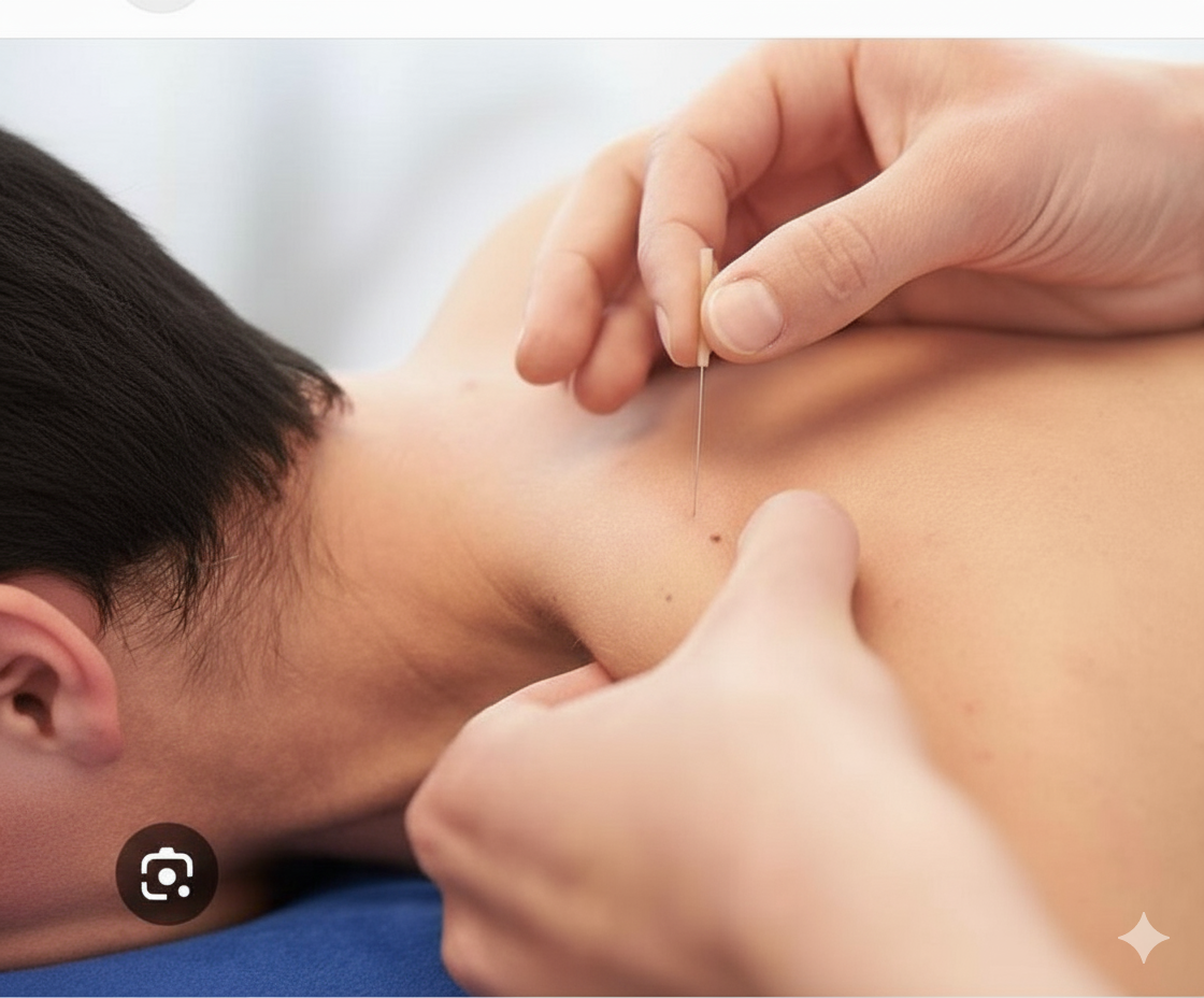 Dry Needling Treatment
